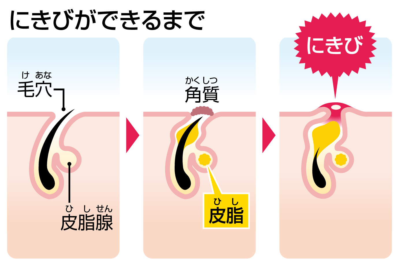 にきびのでき方を詳しく見てみましょう。にきびの原因となるのは皮脂。